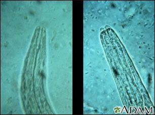 Hookworm - mouth of the organism Hookworm - mouth of the organism