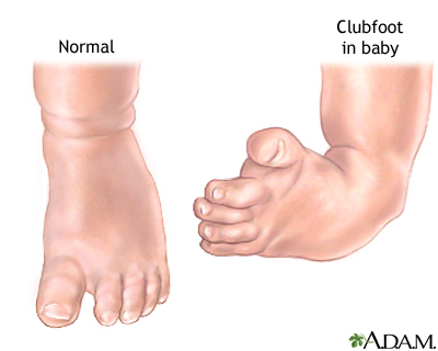 Clubfoot repair - series