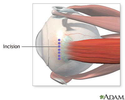 Incision Incision
