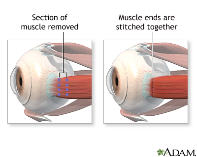 Procedure Procedure