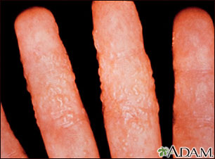 Dermatitis - reaction to tinea Dermatitis - reaction to tinea