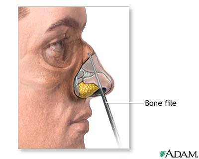 Procedure Procedure