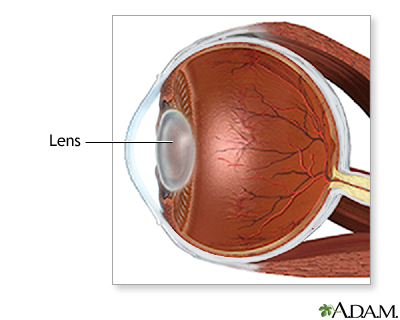 Cataract surgery - series - Normal anatomy Cataract surgery - series - Normal anatomy