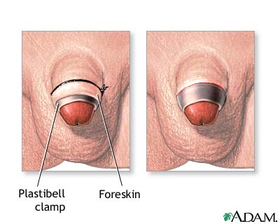 Procedure Procedure