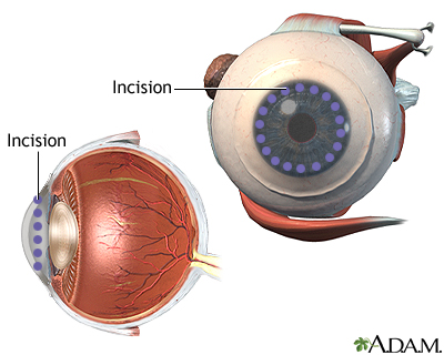 Incision Incision