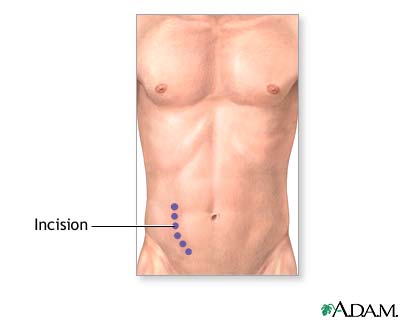 Incision Incision