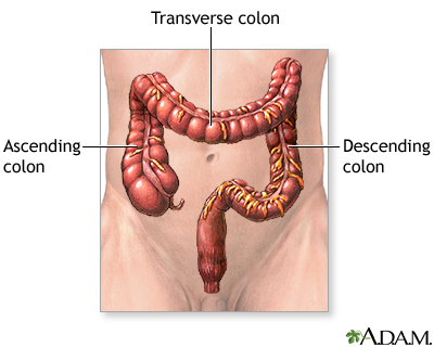 Large bowel resection - series Large bowel resection - series