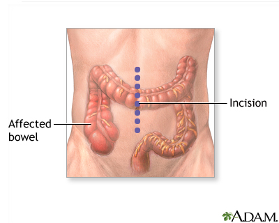Incision Incision
