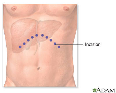 Incision Incision