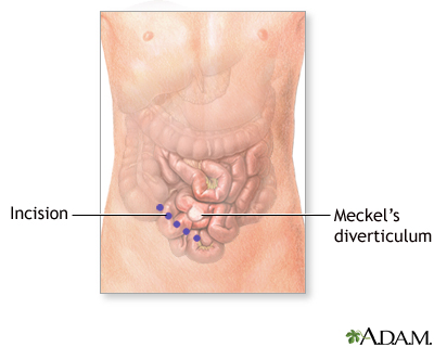 Incision Incision