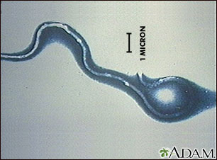 Lyme disease organism - Borrelia burgdorferi Lyme disease organism - Borrelia burgdorferi