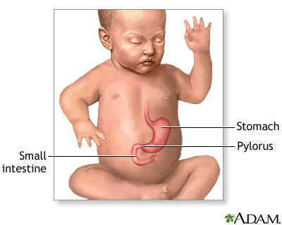 Infantile pyloric stenosis - series Infantile pyloric stenosis - series