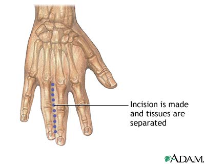 Incision Incision