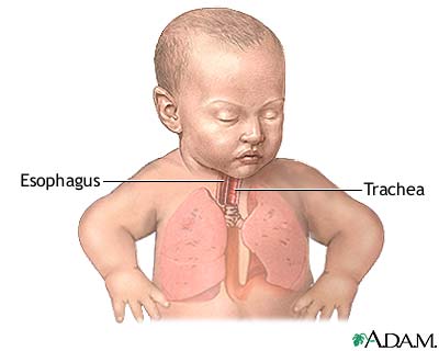 Tracheoesophageal fistula repair - series