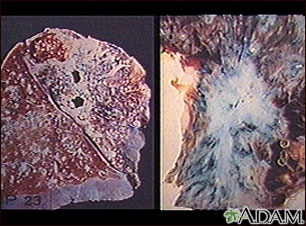 Tuberculosis in the lung Tuberculosis in the lung