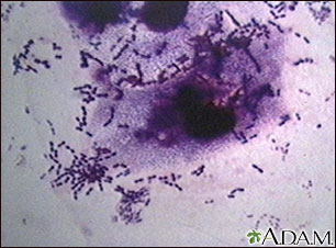 Pneumococci organism Pneumococci organism