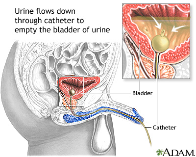 Bladder catheterization - male Bladder catheterization - male