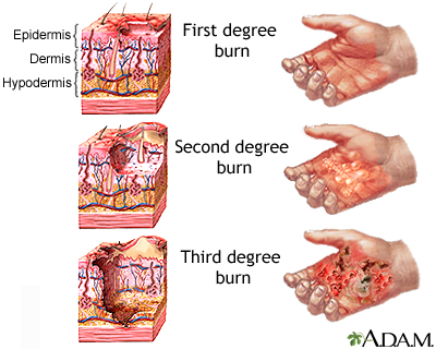 Burns Burns