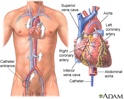 Cardiac catheterization Cardiac catheterization