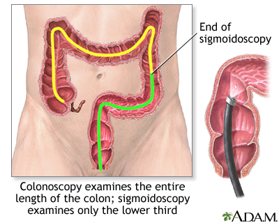 Colonoscopy Colonoscopy