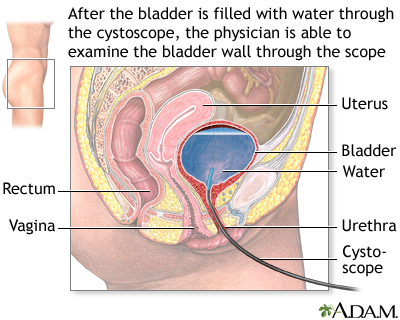 Cystoscopy Cystoscopy