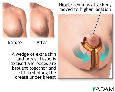 Mammoplasty Mammoplasty