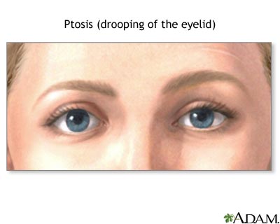 Ptosis - drooping of the eyelid