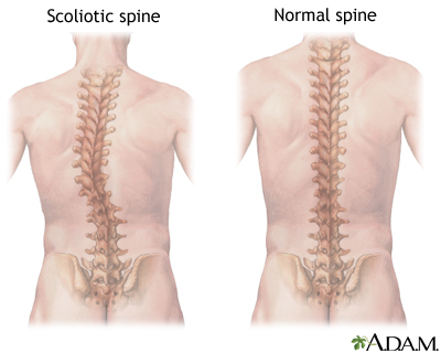 Scoliosis Scoliosis