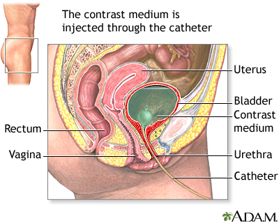 Voiding cystourethrogram Voiding cystourethrogram