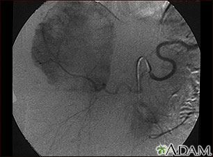 Hemangioma - angiogram Hemangioma - angiogram