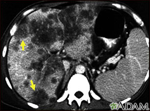 Hepatocellular cancer - CT scan Hepatocellular cancer - CT scan