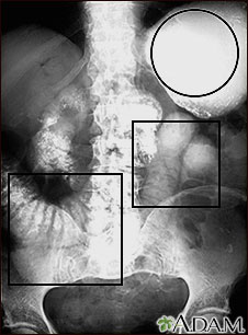 Ileus - X-ray of distended bowel and stomach Ileus - X-ray of distended bowel and stomach