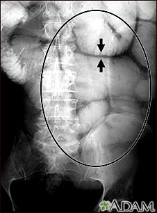 Ileus - X-ray of bowel distension Ileus - X-ray of bowel distension