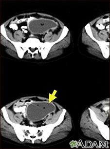 Intra-abdominal abscess - CT scan Intra-abdominal abscess - CT scan