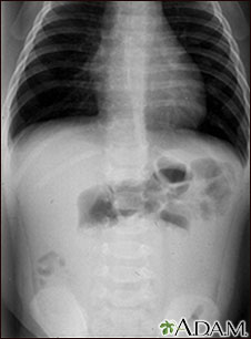 Intussusception - X-ray Intussusception - X-ray