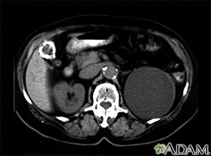 Kidney cyst with gallstones - CT scan Kidney cyst with gallstones - CT scan