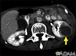Kidney metastases - CT scan Kidney metastases - CT scan