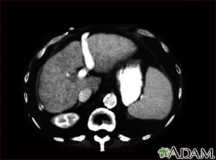 Liver cirrhosis - CT scan Liver cirrhosis - CT scan