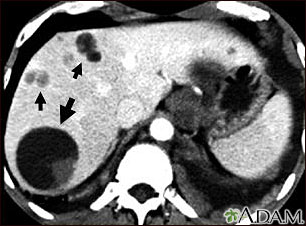 Liver echinococcus - CT scan Liver echinococcus - CT scan