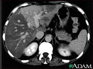 Liver with disproportional fattening - CT scan Liver with disproportional fattening - CT scan