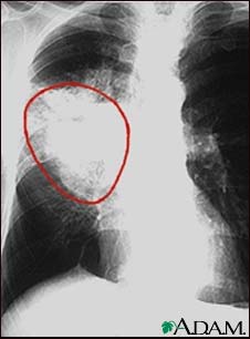 Lung cancer - frontal chest X-ray Lung cancer - frontal chest X-ray