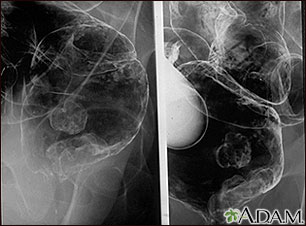 Rectal cancer - X-ray Rectal cancer - X-ray