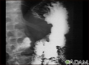 Stomach cancer, X-ray Stomach cancer, X-ray