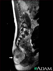 Teratoma - MRI scan Teratoma - MRI scan