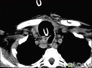 Thyroid cancer - CT scan Thyroid cancer - CT scan