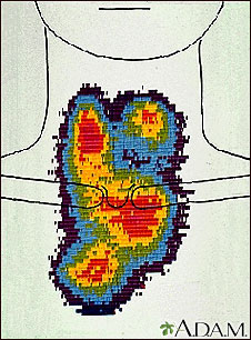 Thyroid enlargement - scintiscan Thyroid enlargement - scintiscan