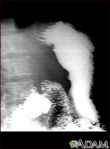 Stomach ulcer, X-ray Stomach ulcer, X-ray