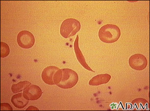 Red blood cells, sickle cell Red blood cells, sickle cell