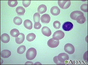 Megaloblastic anemia - view of red blood cells Megaloblastic anemia - view of red blood cells