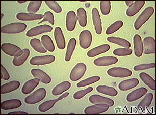 Red blood cells - elliptocytosis Red blood cells - elliptocytosis